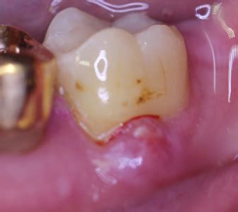 Periapical Abscess (Eiter an der Zahnwurzel)